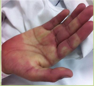 A Teenager With Rash and Fever: Juvenile Systemic Lupus Erythematosus or Kawasaki Disease?